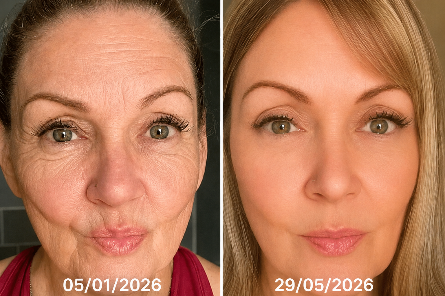 Antes e depois - Rosângela